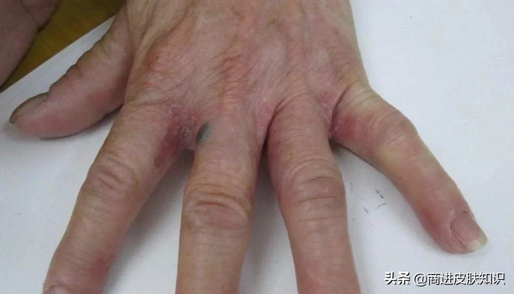 皮炎会传染别人吗,下体皮炎传染吗