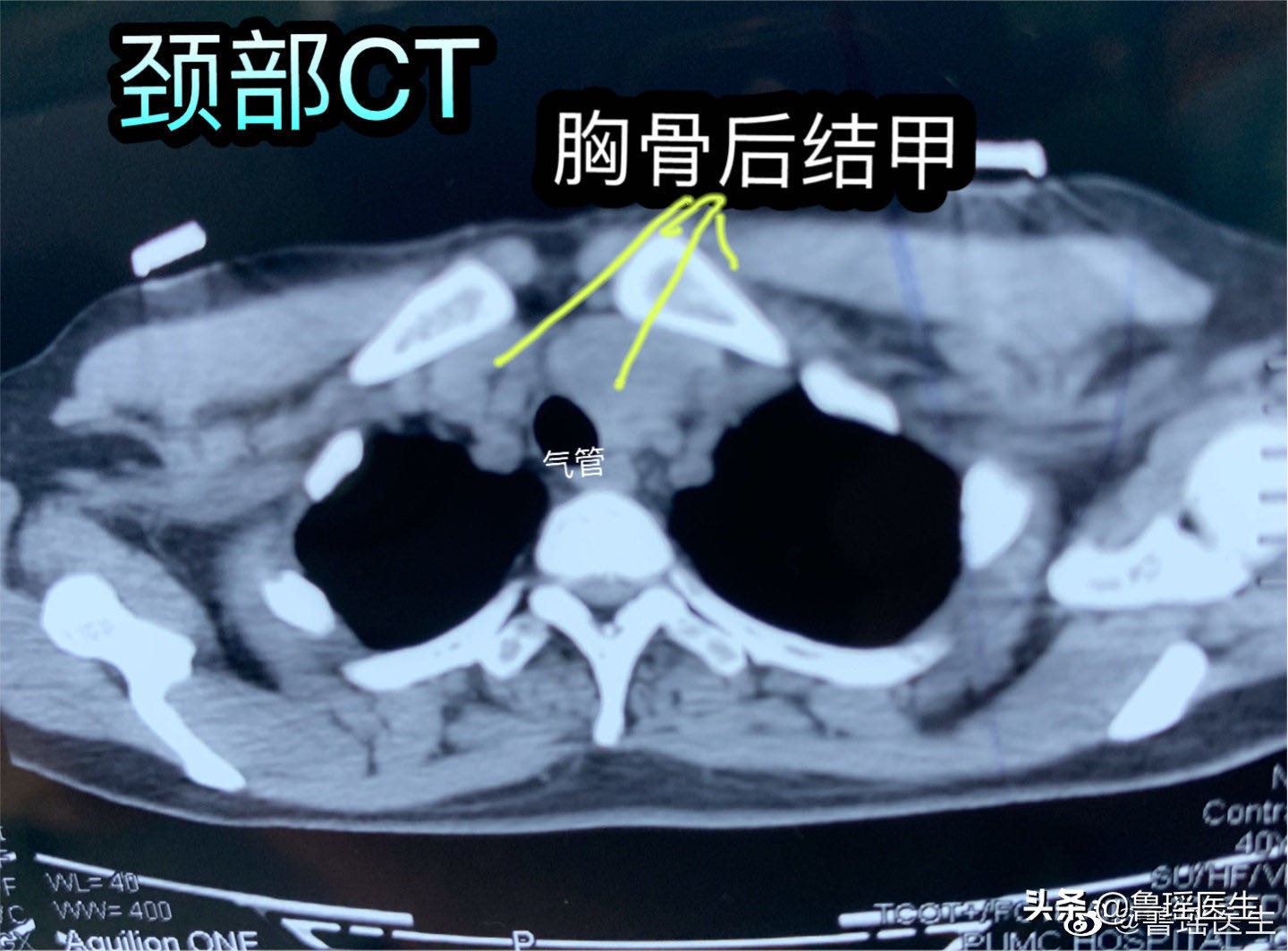 甲状腺结节从生长到发现要多久,甲状腺结节观察3个月会变大吗