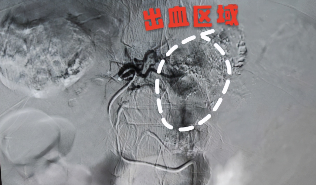 肝癌肿瘤破裂出血会越来越频繁吗,肝癌肿瘤破裂出血能止住吗