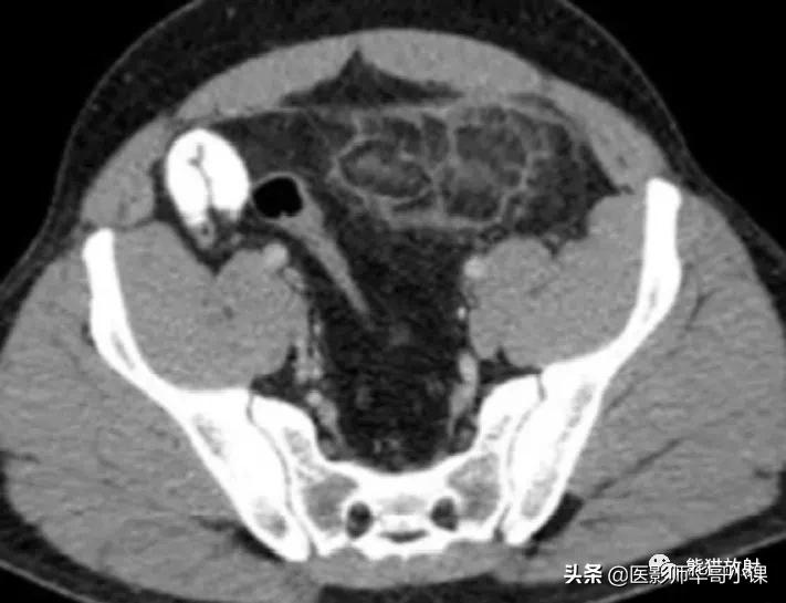 「精品课件」11种腹膜感染/炎症性病变的影像学表现