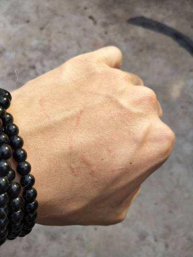 猫狗咬伤如何正确处理,被猫狗抓伤或咬伤的急救