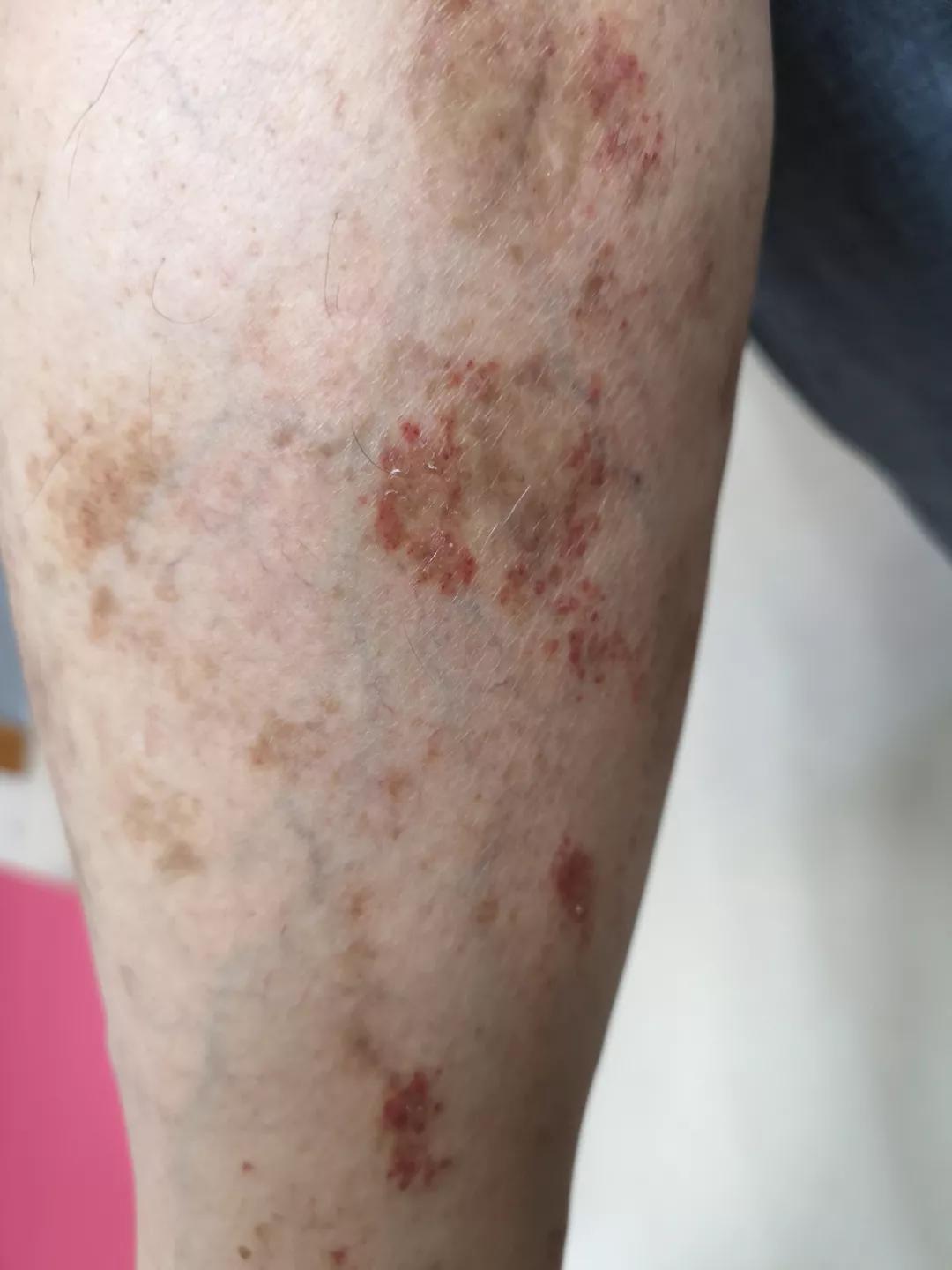 色素性紫癜性皮肤病是啥,色素性紫癜性皮肤病是什么