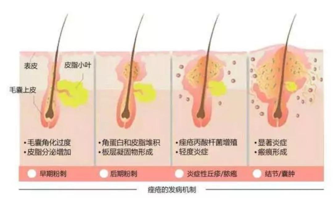 让无数姑娘无从下手的痘印，皮肤科医生有了解决新招