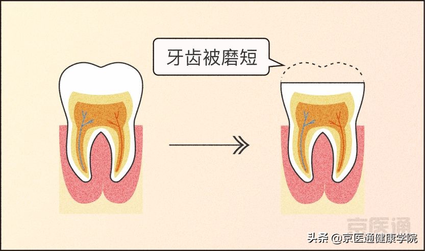 一招解决磨牙的危害,磨牙很严重最好的磨牙解决方法