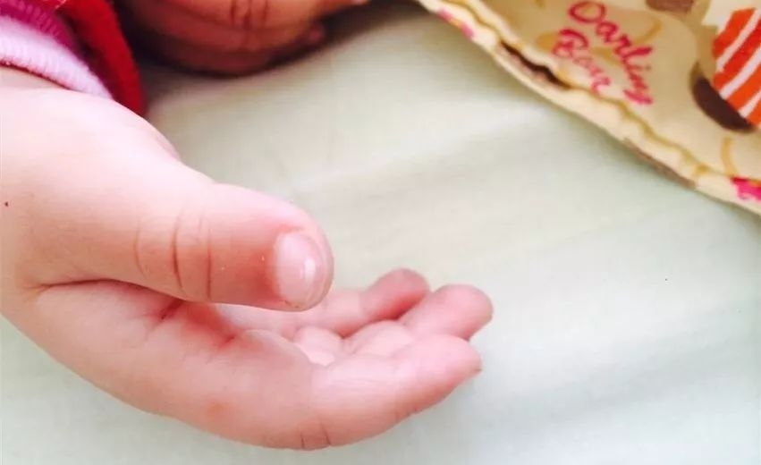 手上出现白点是什么原因造成的,宝宝手上的小白点