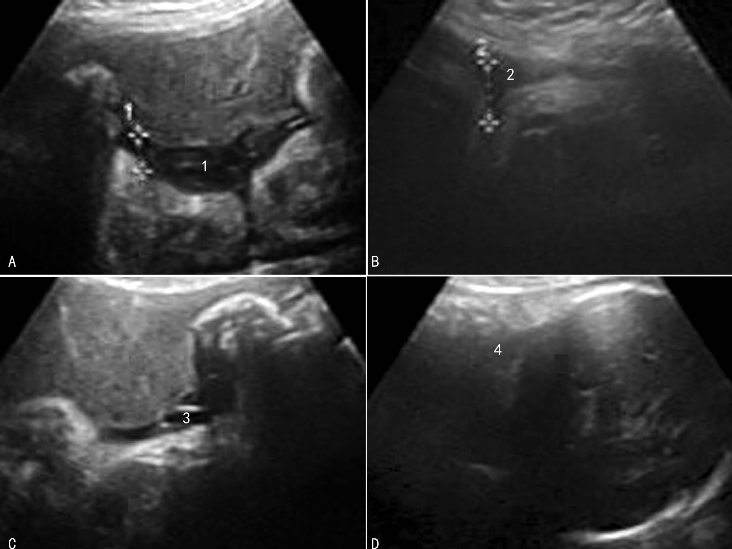羊水彩超和普通彩超哪个更准,羊水异常的超声诊断