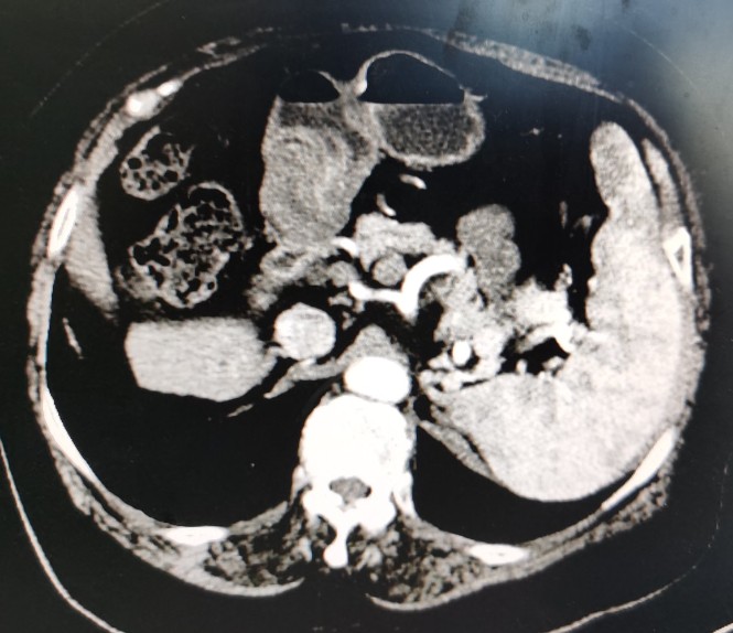 黄婶的肝癌用介入治疗已经3年多了-适合自己的治疗才是最好的治疗