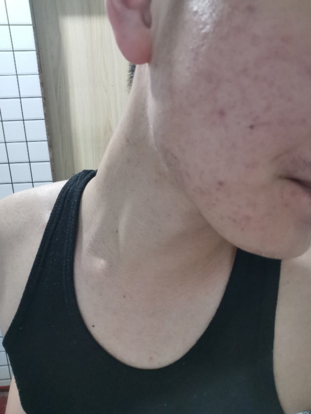 背部痘印黑色素沉淀怎么去除,痘痘痘印怎么去除