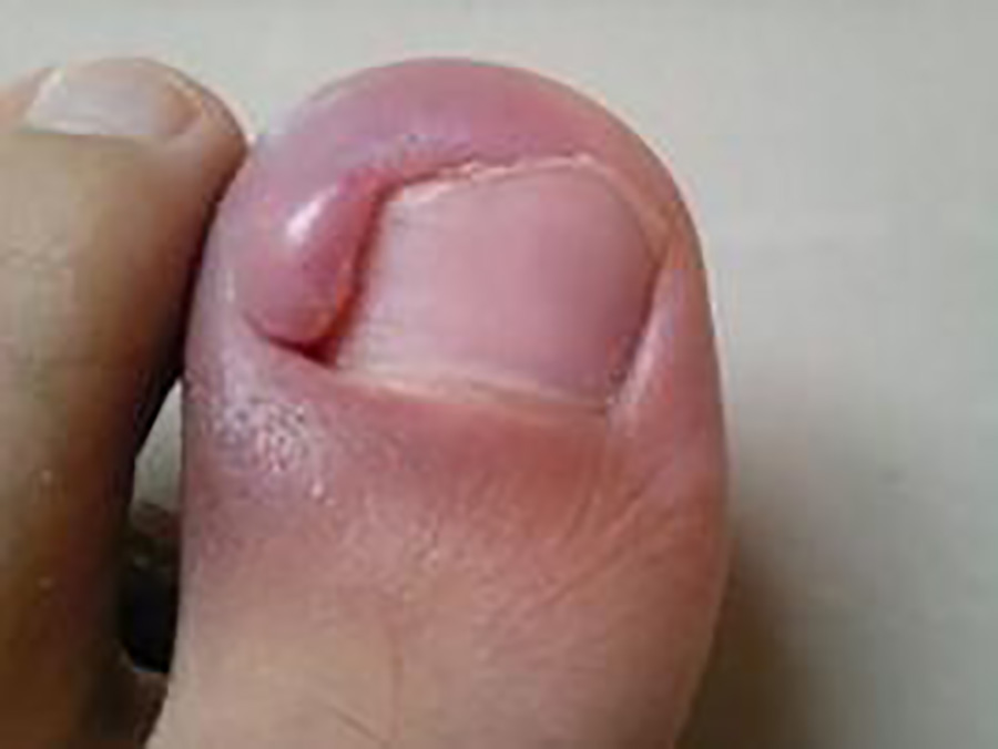 青少年甲沟炎反复发作能艾灸吗,甲沟炎反复怎么治疗才能彻底除根