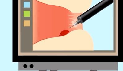 散步可治痔疮,睡前一招治外痔疮