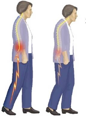 腰椎管狭窄一般是怎么引起的,腰椎管狭窄是什么症状怎么治疗