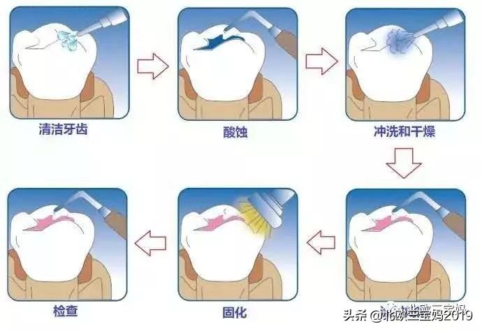 5岁小孩打全麻治蛀牙有影响吗,3岁孩子全麻风险大吗