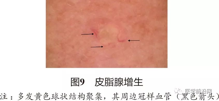 面部常见皮肤病皮肤镜诊断专家共识全文发布