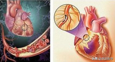冠心病能治好吗,冠心病能治好吗最真实的经验分享
