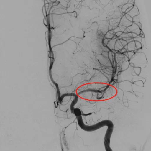 颅内动脉支架成形术，让塌陷的颅内动脉重获新生