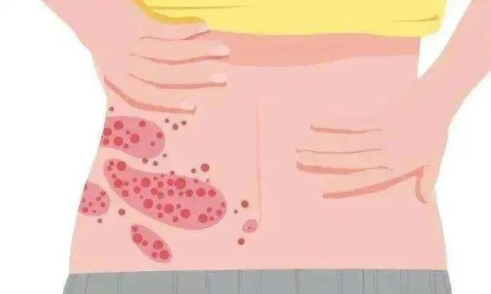 蔡依林、马思纯纷纷中招？痛如刀割的带状疱疹，真的致命吗？