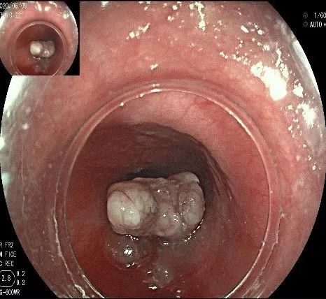 贲门隆起性病变影像,贲门溃疡隆起性病变