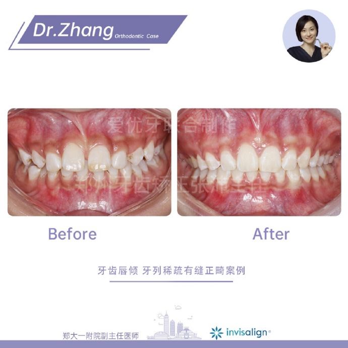 郑州矫正牙齿整形哪个医院好,郑州牙齿局部矫正