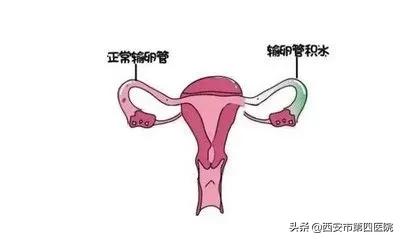 输卵管积水微创手术怀孕几率多少,中医治疗输卵管积水的孕妈