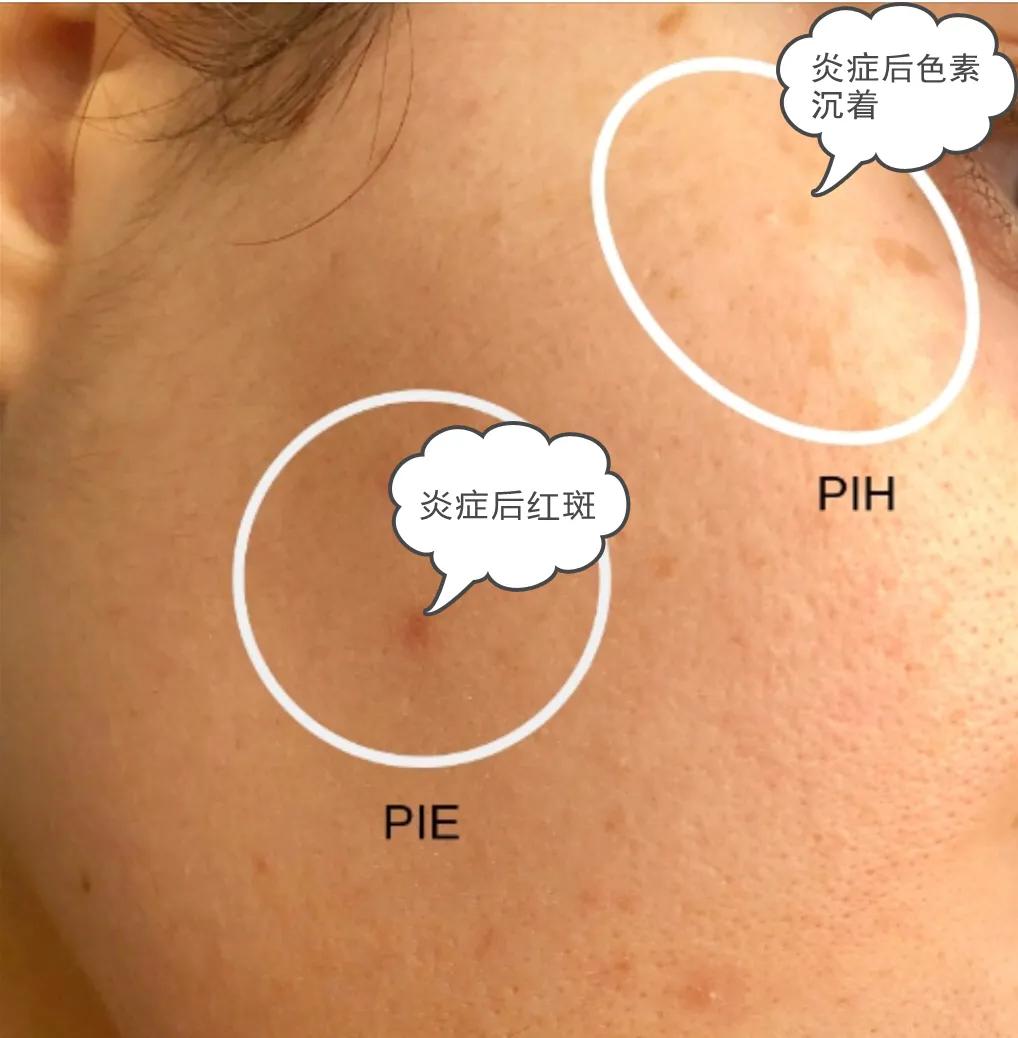 疱疹后遗症已三年了怎么办,痤疮后红斑怎么去除