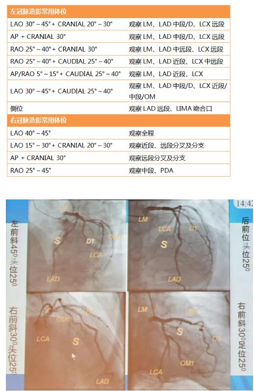 清晰完整揭秘冠脉造影全部过程,冠脉造影教学视频