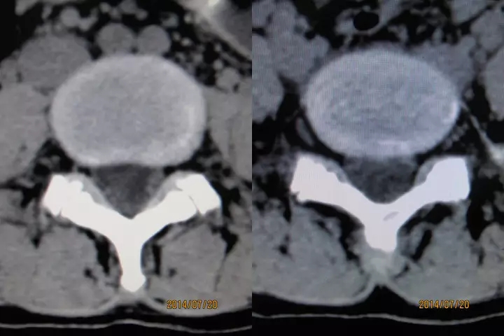 颈椎腰椎疾病ct及mri诊断,腰椎ct可以发现肠部病变吗