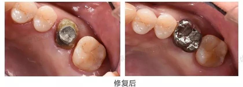 牙齿缺损全瓷冠修复多少钱,牙齿楔状缺损修复大概多少钱