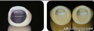 烤瓷牙黄可以通过刷牙变白吗,烤瓷牙能变白吗