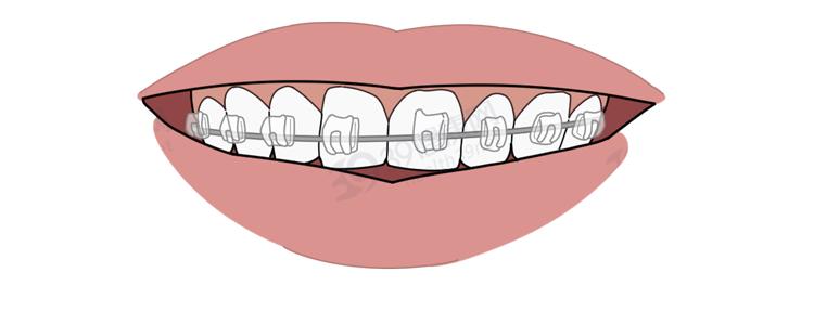 隐形牙套能矫正整齐吗,为什么戴牙套会让人变好看
