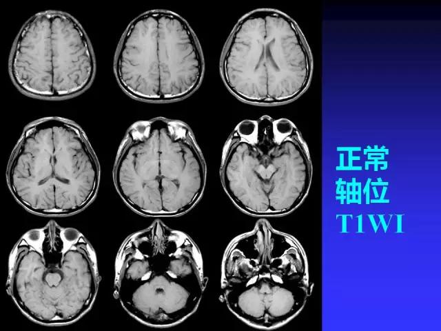 头颅mri读片视频教程,颅脑mri读片入门教程视频讲解全集