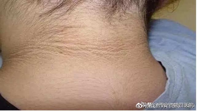 脖子发黑怎么都洗不干净怎么办,脖子发黑洗不掉像脏兮兮怎么办