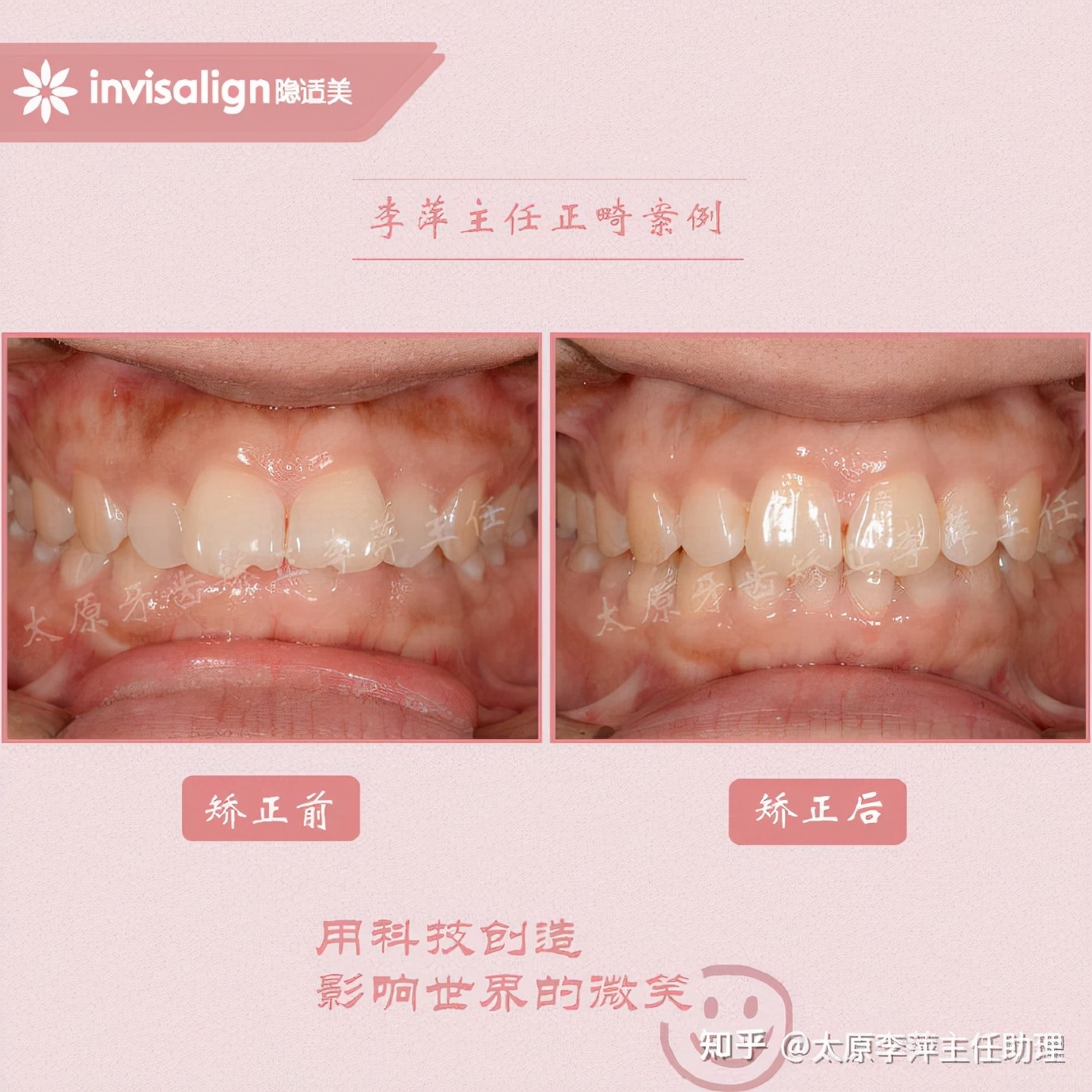 太原牙齿矫正靠谱吗,太原成人隐形牙套牙齿不齐