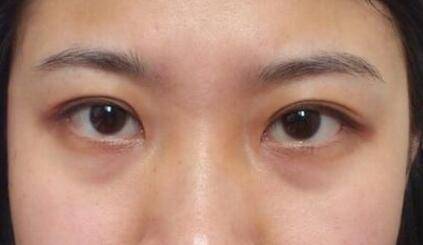 熬夜引起的泪沟黑眼圈能消失么,万年黑眼圈眼袋泪沟怎么遮瑕