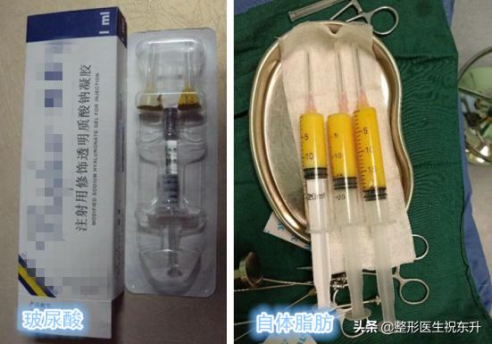 自体脂肪丰苹果肌的效果如何,填充苹果肌用自体脂肪还是玻尿酸