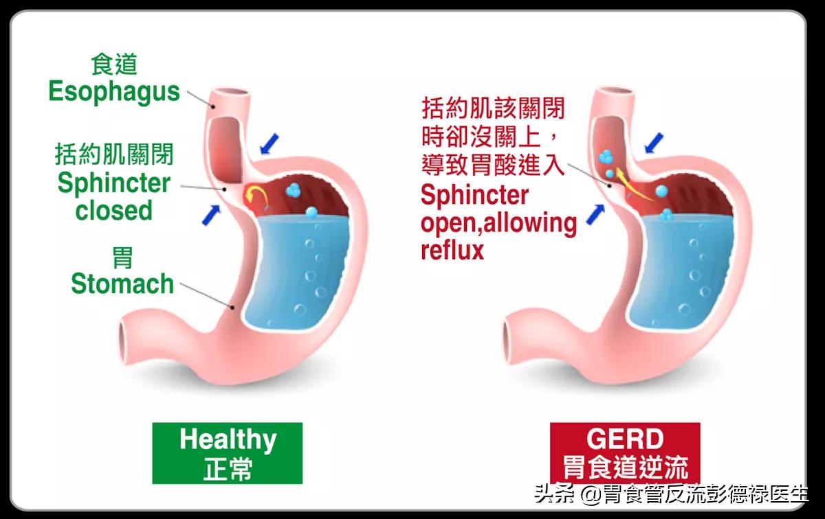 老是干咳恶心什么原因,总是干呕咳嗽恶心想吐怎么回事