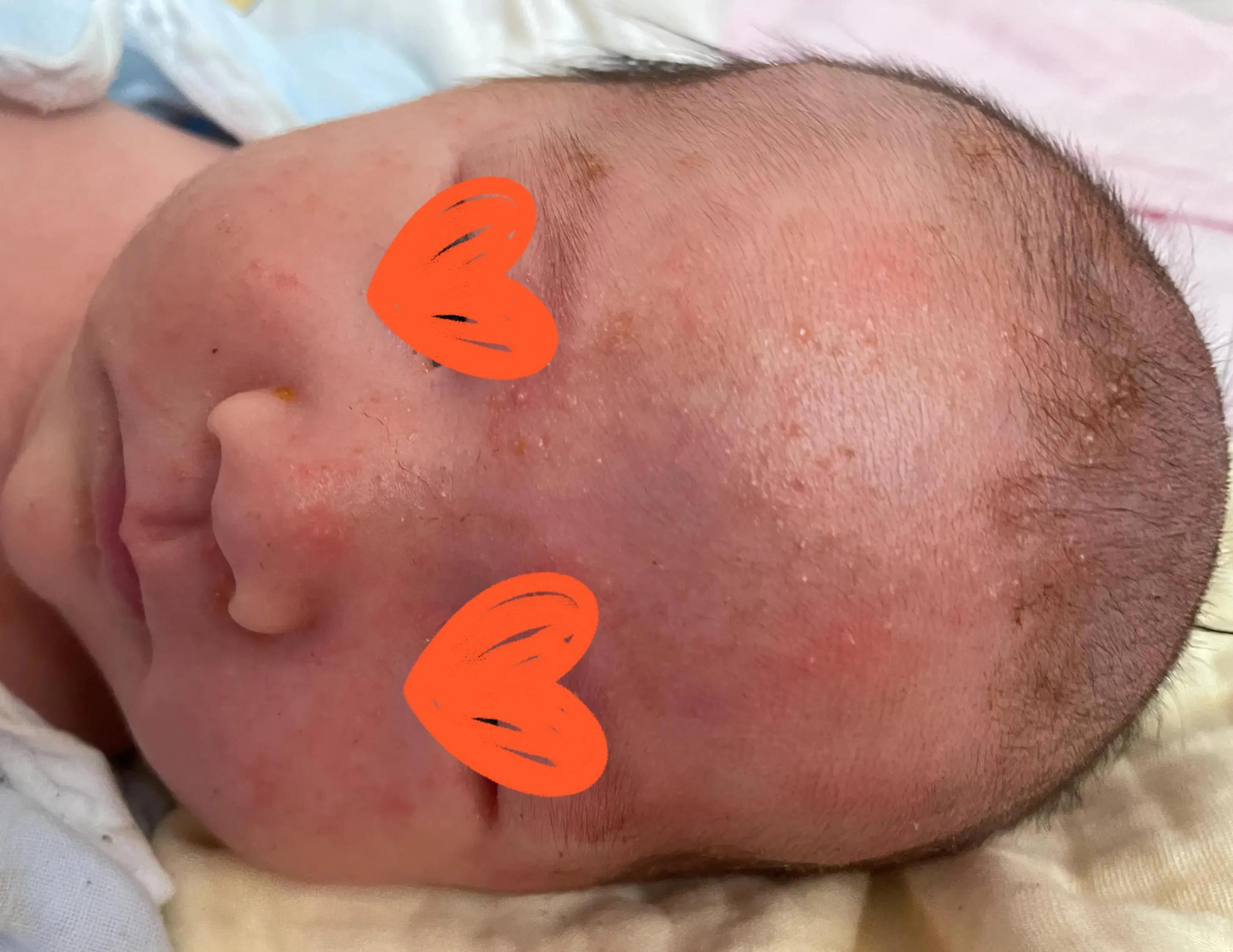 养宠物会不会造成孩子湿疹,宝宝湿疹跟家里养宠物有关系吗