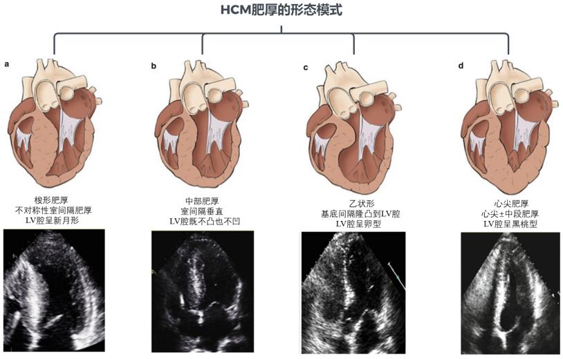 胸闷气短心电图有变化,冠脉造影正常但有胸闷心绞痛症状
