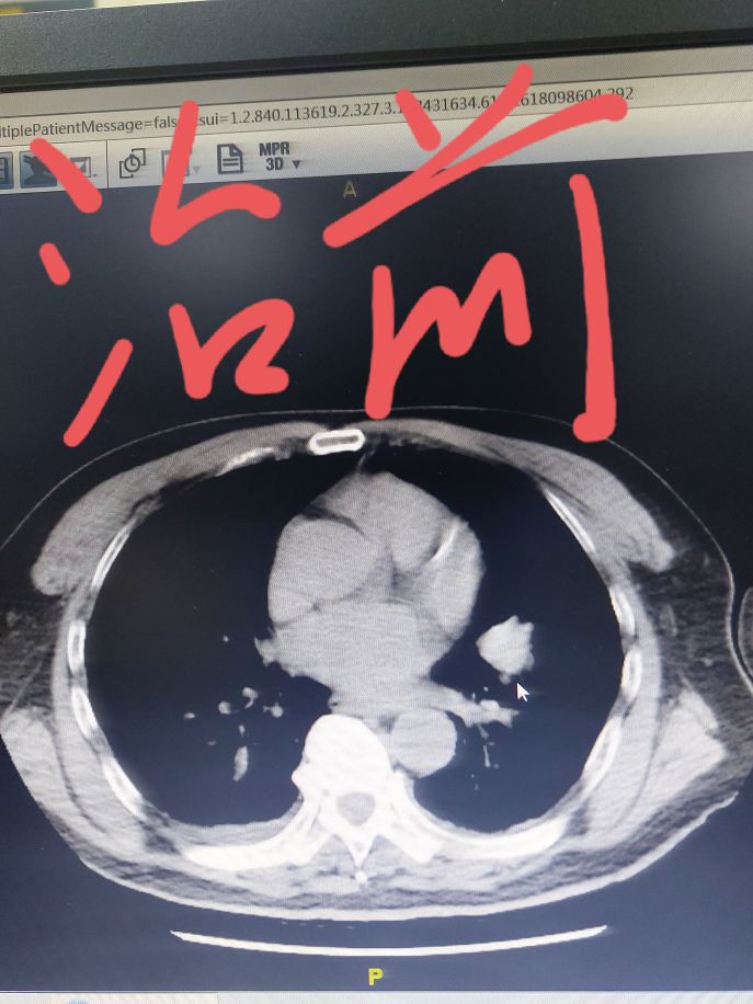 刘懿谈肺癌治愈率,刘懿谈肺癌病理报告