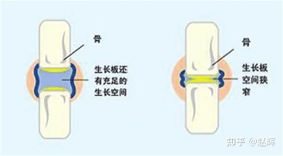每天坚持摸高,每天摸高400下没长高反而矮了