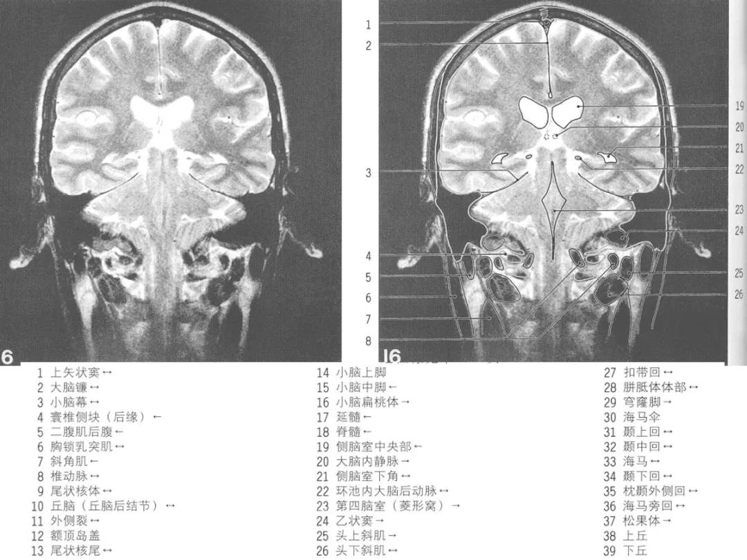 颅脑冠状状切面解剖图,颅脑mr解剖结构图