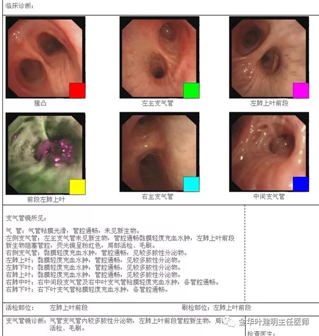 手术引起乳糜胸,有没有做了肺结节手术后是误诊的