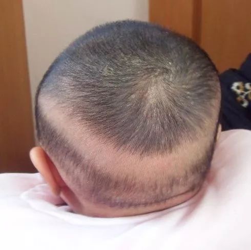 宝宝一吃就拉，喉咙总有痰？排雷新生儿特有现象32种（下）