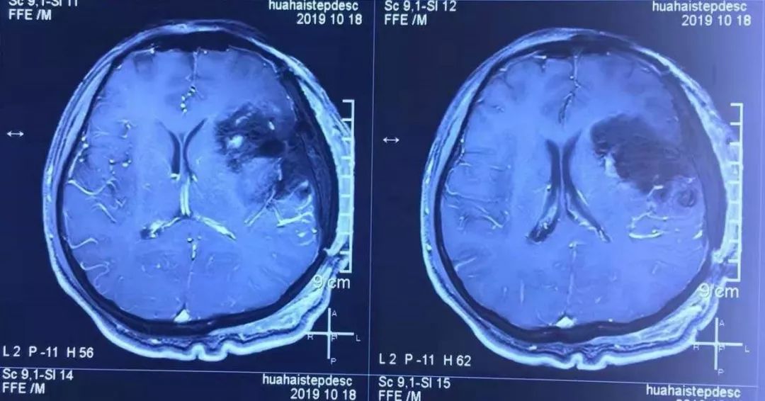 西安国际医学中心脑科,西安国际中心医院下丘脑手术