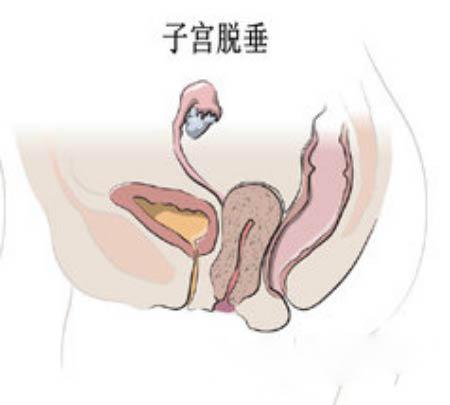 60岁跳广场舞子宫脱落,大妈跳广场舞身上掉了一块肉