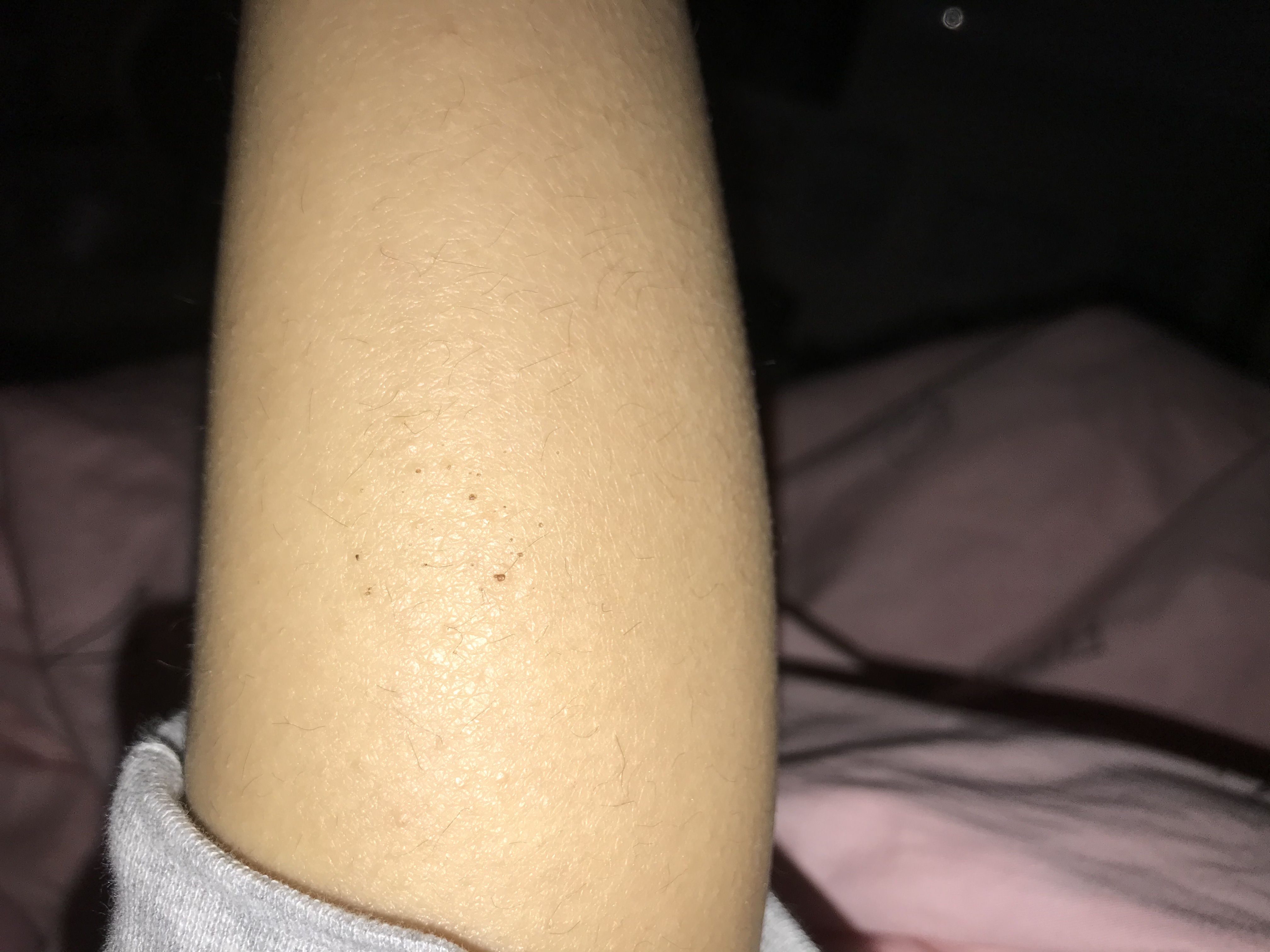 宝宝腿痒抓了变成水泡,孩子腿部皮肤瘙痒挠破怎么办