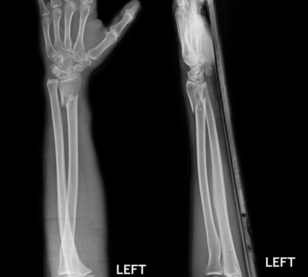 骨折后保守治疗需要注意什么,骨折手术有几种固定方法