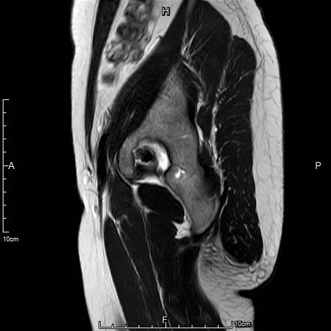 子宫腺肌症介入栓塞全国哪里好,子宫腺肌症介入栓塞治疗报销吗