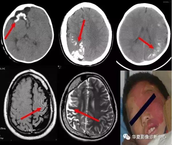 颅脑核磁影像解剖图谱,颅脑mr增强影像图片