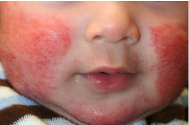 皮炎湿疹抗真菌药膏,皮炎湿疹抗过敏的药