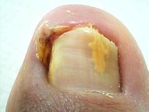 一文解答：甲沟炎的诊断方法和检查项目都有哪些？